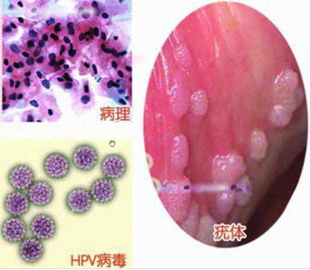 尖锐湿疣图片