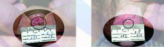 尖锐湿疣的治疗