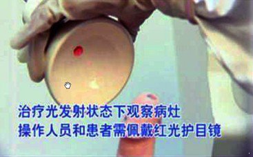 尖锐湿疣的治疗