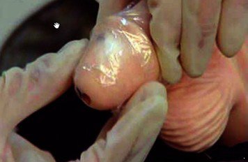 尖锐湿疣的治疗