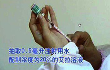 尖锐湿疣的治疗