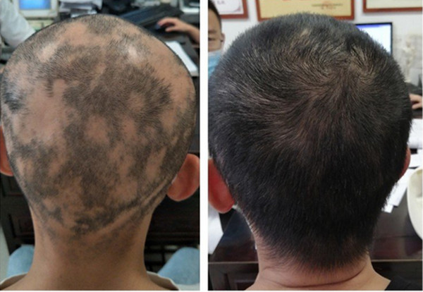 长春哪里能治疗斑秃