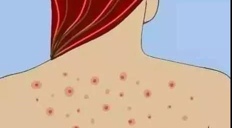 毛囊炎和青春痘有什么区别