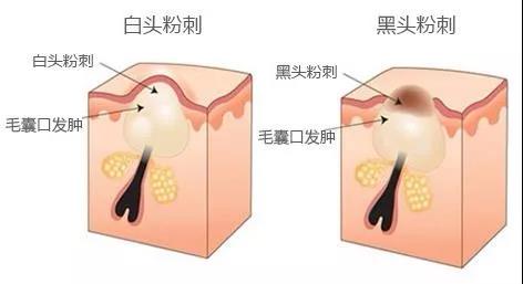 什么是粉刺?粉刺是怎么形成的
