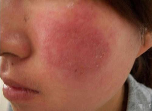 激素脸有哪些症状