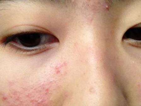 激素脸有哪些症状