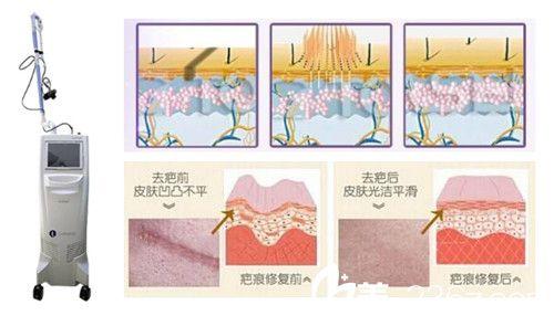 激光祛疤一次就能好吗