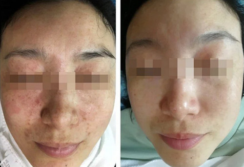 长春哪里治疗雀斑比较好