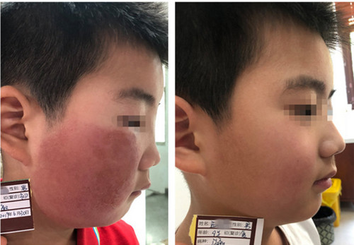 脸过敏了去长春哪里治