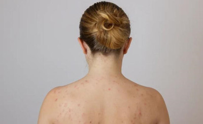 长春胸前背后长痘痘怎么治