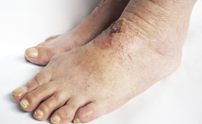 皲裂性湿疹用什么药最好