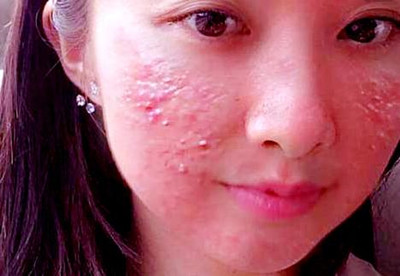 激素脸怎么治疗修复好得快