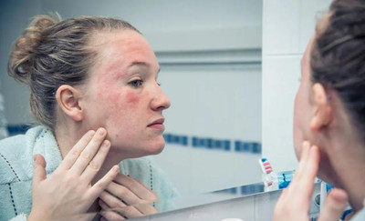 脸部过敏性皮炎会自愈吗