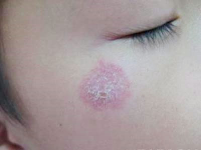 钱币状湿疹是由什么引起的?