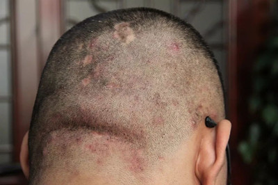 ͷƤ֬����ë���׵�֢״