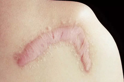 增生疤痕可以手术切除吗