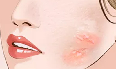 长春哪些医院可以治疗凹陷疤痕