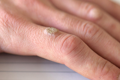 手上的猴子怎么样能快速去掉