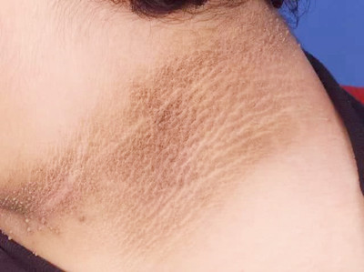 �ڼ�Ƥ����ô����