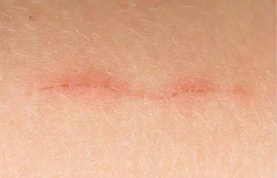 红色疤痕怎么变回肉色