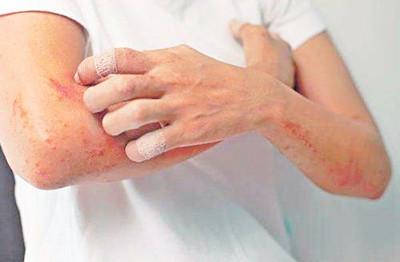 神经性皮炎是怎么回事