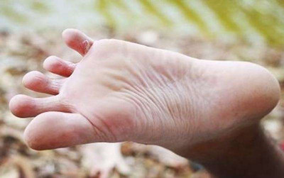 浸渍糜烂型足癣的治疗方法