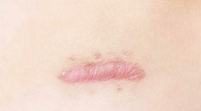 增生疤痕会自然消退吗