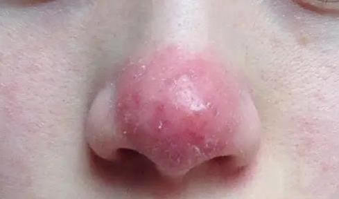 玫瑰痤疮患者,平时要如何护理皮肤?