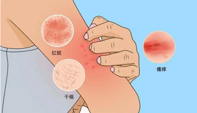 春季容易皮肤瘙痒, 原来是这4个原因造成的!